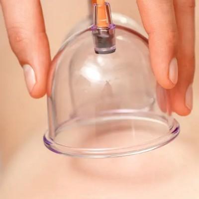 cupping therapy